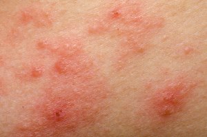 Eczema Atopic Dermatitis