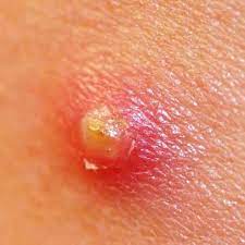 Boils Abscesses