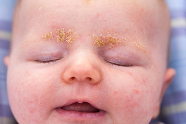 Cradle Cap