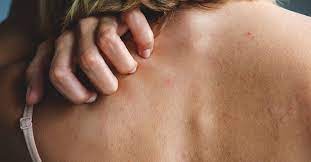 Drug Rashes