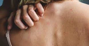 Drug Rashes