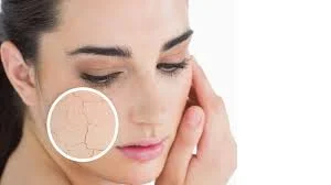 Dry Skin