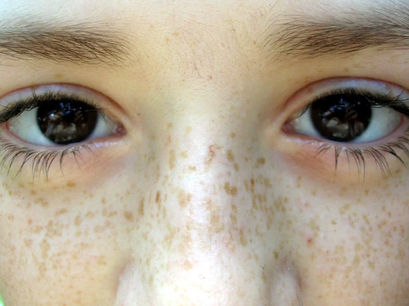 Freckles