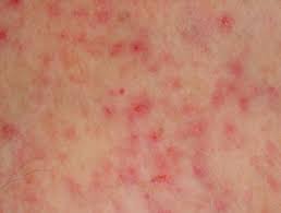 Heat Rash Miliaria