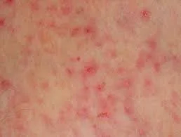 Heat Rash Miliaria