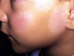 Pityriasis Alba