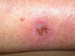Wound Skin Infection
