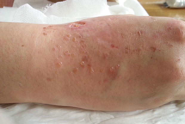 Skin Disease