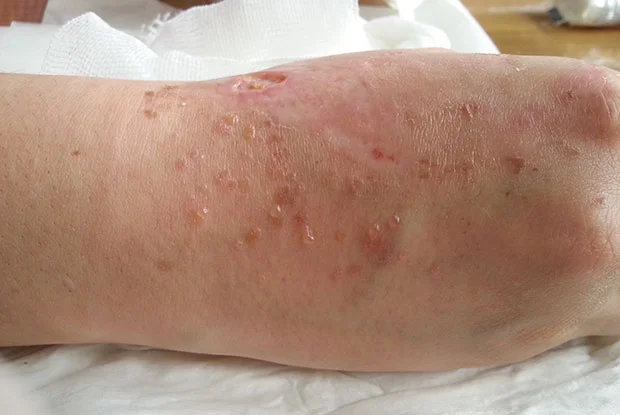 Skin Disease
