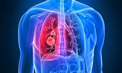Lung Disease
