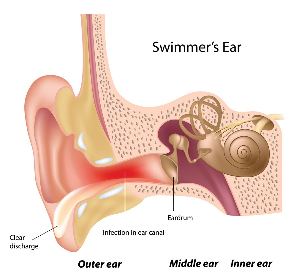 Swimmers Ear Otitis Externa