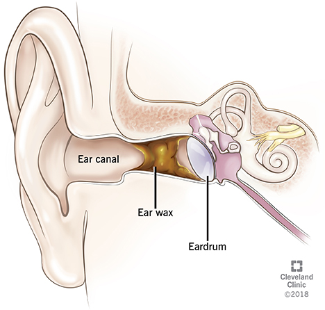 Earwax Problems