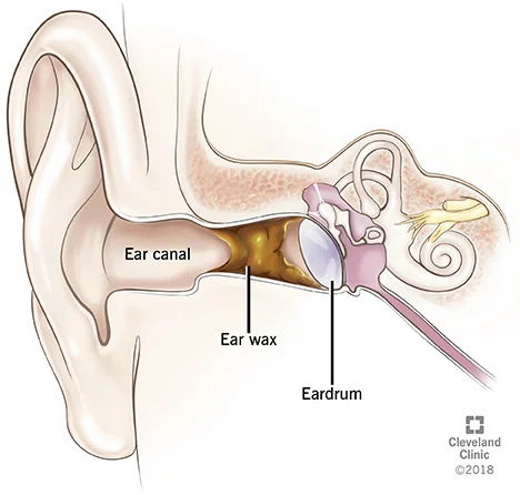 Earwax Problems