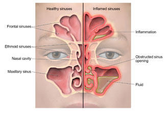 Sinus Congestion