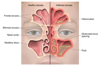 Sinus Congestion