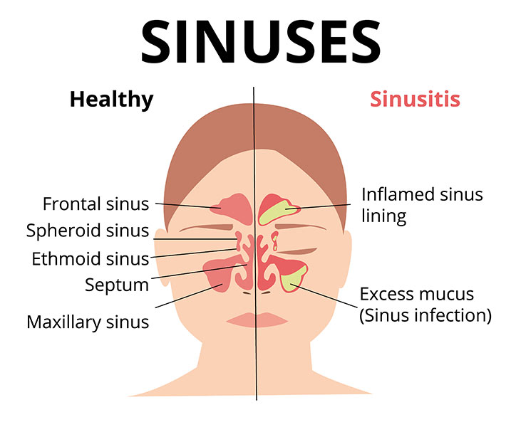 Sinus Infection