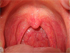 Sore Throat Pharyngitis