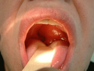 Sore Throat Pharyngitis For Teenagers