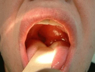 Sore Throat Pharyngitis For Teenagers